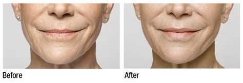 We did not find results for: Restylane Silk in Washington DC and Olney - Cosmetic Skin ...