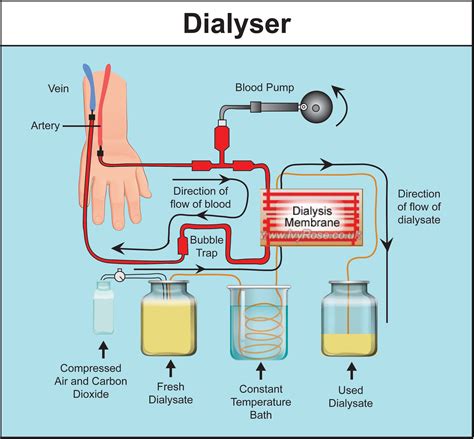 Dialysis Complete Information About Dialysis And Its