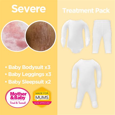 Severe Eczema Baby Pack For Treatment Of The Skin Happyskin