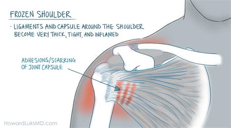 Shoulder Pain When Lifting The Arm Causes And Cures Howard J Luks Md