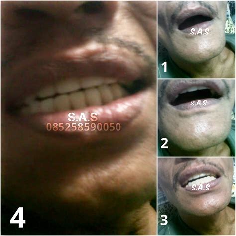 Prosthodonti adalah pembuatan restorasi gigi atau mengganti gigi yang hilang dengan berbagai jenis gigi palsu seperti gigi tiruan cekat, lepasan, veneer atau implan gigi. Koleksi Foto Gigi Palsu Lepasan / Lepas Pasang (Akrilik ...