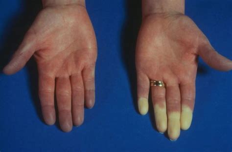 Raynauds Phenomenon Treated Effectively With Topical Nitrates