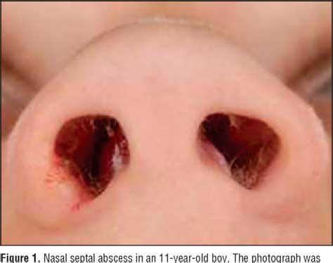 Figure 1 From Nasal Septal Abscess In Children Reconstruction With