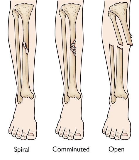 A line spiraling around the entire certain fractures sustained during childhood are typically related to accidental trauma, such as spiral fractures of the tibia in newly ambulating toddlers and clavicular fractures in. Tibia (Shinbone) Shaft Fractures - OrthoInfo - AAOS