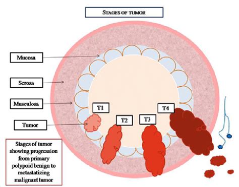 D The T Stages Of Colorectal Cancer Starting From T1 And Progressing
