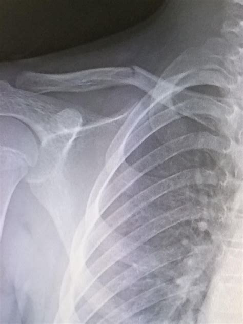 This Is What A Broken Collar Bone Looks Like Nuclear Medicine Med