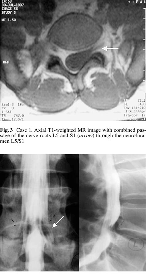 Case 2 Myelography With Prolapsing Disc L4l5 And Associated Spinal