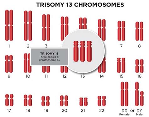 Trisomy 13 Patau Syndrome Types And Diagnosis Ssm Health