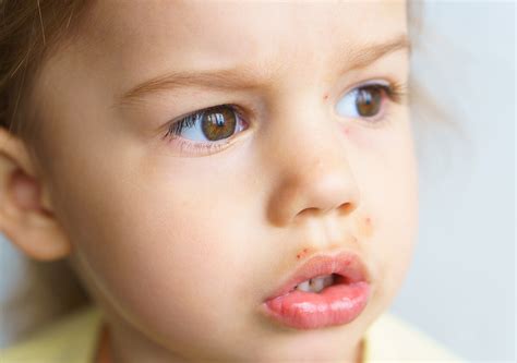Face Rashes In Children Plano Dermatologist Plano 75093