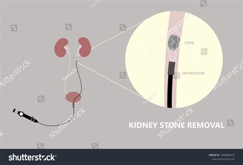 Ureteroscope Ureteroscopy Procedure Remove Kidney Stones Stock
