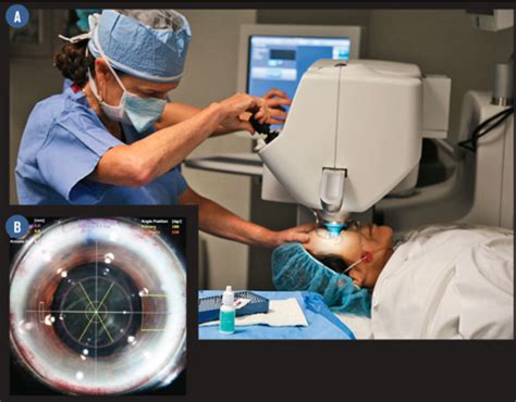 Unlock The Potential Of Refractive Surgery Optometry Times