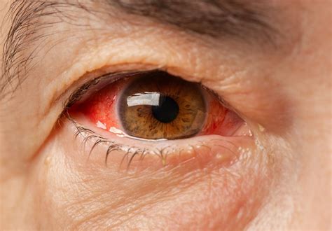 Red Eye Symptoms And Treatment