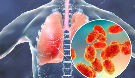 Symptoms And Complications Of Bacterial Pneumonia Entirely Health