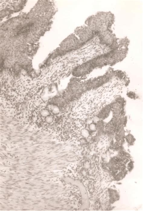 Histology Of The Specimen Revealed Esophageal Tissue Consistent With