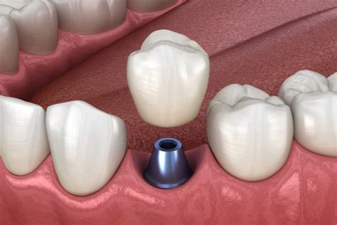 What To Do If An Implant Crown Falls Out Smiles By Julia Fort Lauderdale Florida