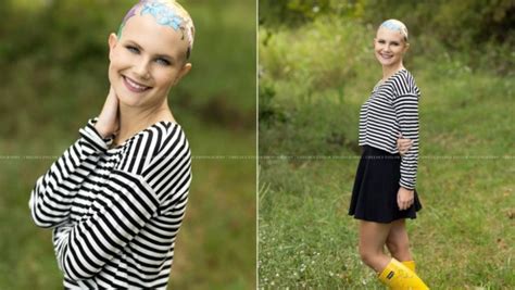 Teen With Alopecia Takes Incredible Photos To Raise Awareness You