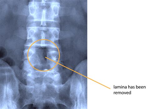 Lumbar Decompression Laminectomy Rajiv Bajekal