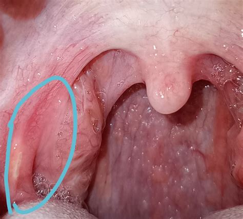 Painful Lump By Tonsil Opinions Pls Rcankersores