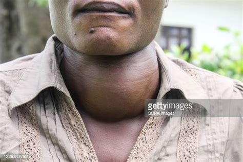 Goitre Disease Photos And Premium High Res Pictures Getty Images