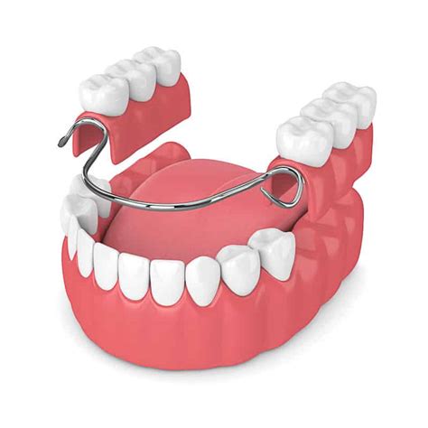 Do Partial Dentures Need To Be Removed At Night Sleemanwisely