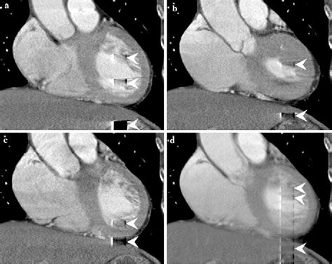 Partial Ring Artifact On Cardiac Ct Image Presentation And Clinical
