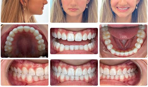 Invisalign Teen Clear Aligners Marin Orthodontist For Kids