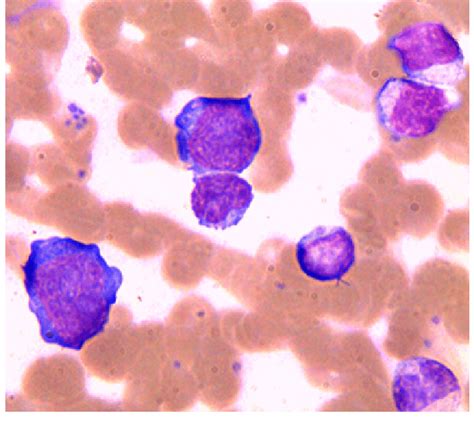 Atypical Lymphocytes In Child Cooperstuart