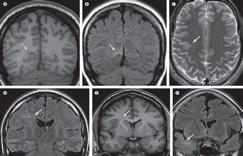 Focal Cortical Dysplasia Type Ii Biological Features And Clinical