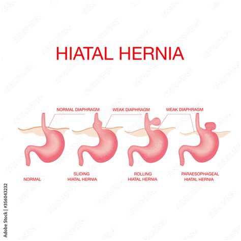 Plakat Hiatal Hernia Vector Diagram Of Normal Anatomy And Sliding