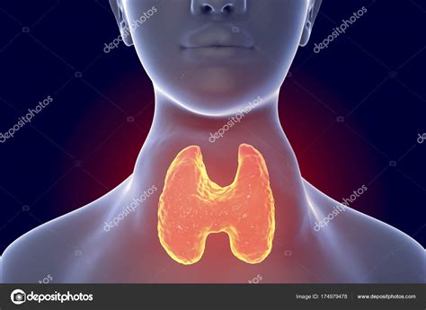 Toxic Diffuse Goiter Hyperthyroidism — Stock Photo © Katerynakon