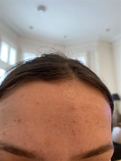 How Do I Improve My Bumpy Forehead Routine In Comments Racne