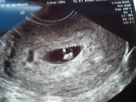 6 Week Ultrasound Pic Babycenter