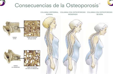 Osteoporosis Salud Y Medicina