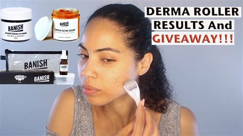 Derma Roller Acne Scars Results Demo And Review Giveaway Youtube