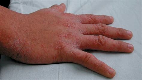 Difference Between Hives And Scabies Youtube