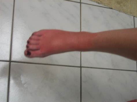 Ems Sunburned And Swollen Feet Flickr Photo Sharing