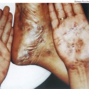 Las personas que son alérgicas a la penicilina probablemente será tratado con un antibiótico. SÍFILIS: SINTOMAS E TRATAMENTO. ~ Equipe Cascatinha ...