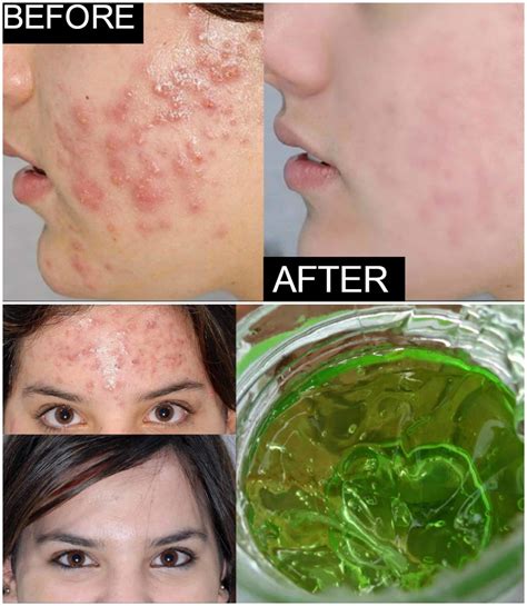 Effective Homemade Aloe Vera Acne Remedies That Will Do Wonders For