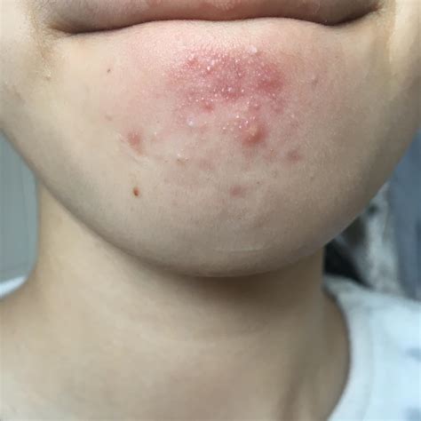 Closed Comedones Or Fungal Acne How Do I Treat Get Rid Of Them R Fungalacne
