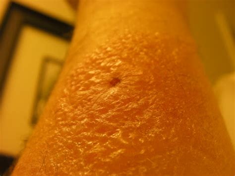 Kris Humphries Brown Recluse Spider Bite Pictures Day 1