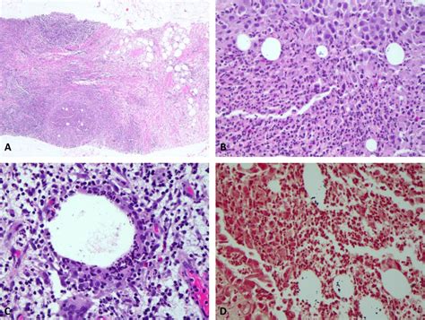 Cystic Neutrophilic Granulomatous Mastitis An Update Journal Of