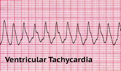 Pulseless Ventricular Tachycardia Ecg