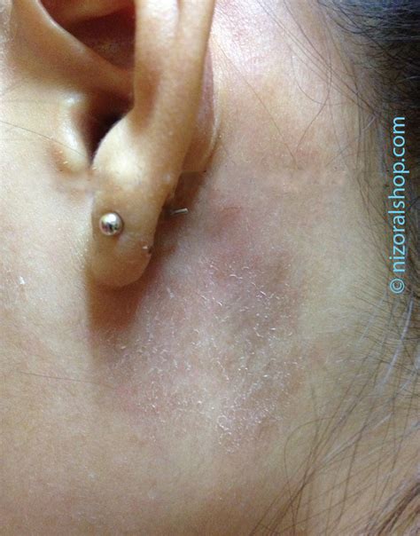 Dry Flaky Skin Behind Ears Toxoplasmosis