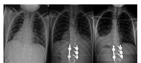Chylothorax Following Anterior Thoraco Lumbar Spine Exposure A Case