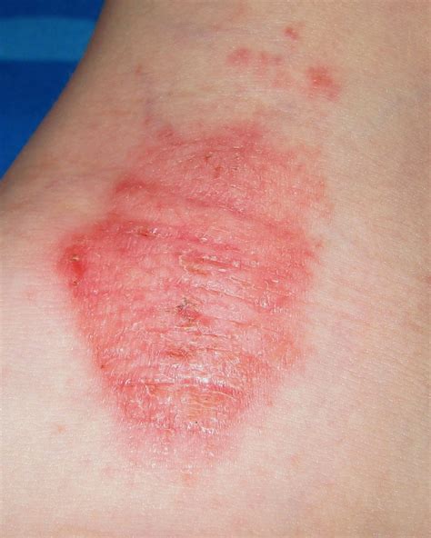 Eczema Skin Rashes Adults