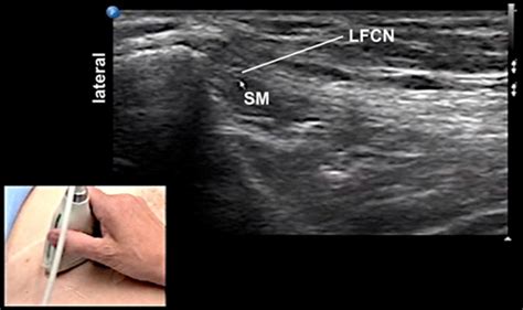 Usra Lateral Femoral Cutaneous Nerve Block