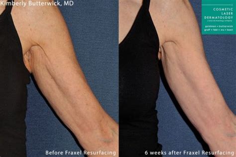 Crepey Skin Arm Treatment San Diego Ca Clderm