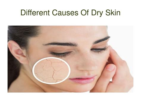 Ppt Different Causes Of Dry Skin Powerpoint Presentation Free