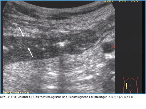 Want to learn more about it? Abbildung 2: Sonographie einer entzündlich verdickten Darmwand