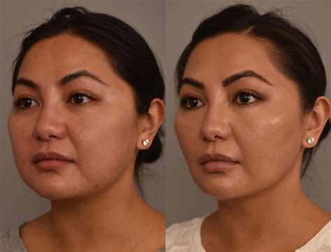 Cheek Liposuction Before And After Photo Gallery New York Ny